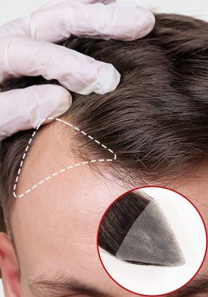 Temple Patch | Tupé tipo Parche de Skin de 0.06mm para área de las Sienes (2 pzas) - Realistas y de Fácil Colocación